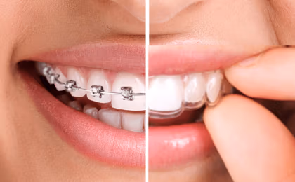 El éxito de la ortodoncia Invisalign como tratamiento para mejorar la sonrisa